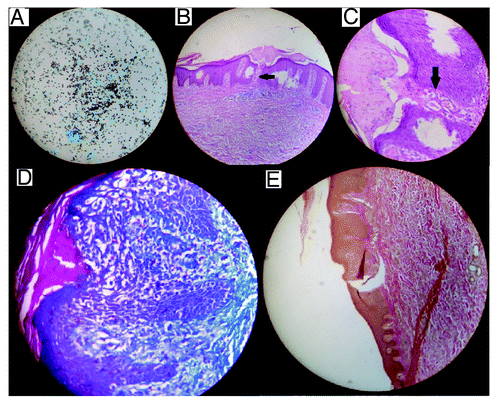 Figure 3. (A) Methanamine silver staining of adrenal fine needle aspiration showing numerous oval yeast cells suggestive of histoplasma capsulatum (×400 magnification). (B) Hematoxylin and eosin staining of skin biopsy showing transepidermal elimination of dermal contents (×100). (C) Higher magnification (×400) showing transepidermal elimination of dermal contents. (D) Masson’s trichrome staining of skin biopsy showing intensely blue staining of collagen within the epidermifigs (×400). (E) Verhoeff van Gieson staining of skin biopsy showing brown staining for elastin sparing the epidermal channel (×100).