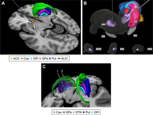 Figure 2 Targets proposed for DBS treatment in Tourette’s syndrome: (A) anterior limb of internal capsule/accumbens; (B) bilateral centromedian-parafascicular complex targeted in an anterolateral thalamic view (basal, anterior, and lateral thalamic views of the right thalamus are displayed for localization within the thalamus); and (C) different parts of GPi. Electrode 1 is located in the posteroventrolateral GPi and electrode 2 is located in the anteromedial GPi. The 3D representations are histological postmortem reconstructions of the nuclei from the University of São Paulo – Würzburg Atlas of the Human Brain (Alho et al, 2018Citation96).