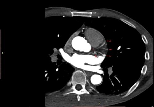 Figure 2 The patient’s cardiac computed tomography angiography cross-sectional view illustrating the absence of the left main coronary artery (encircled in red) with the retrograde opacified left anterior descending (LAD), circumflex arteries (LCx) with their sub-branches, diagonal (D) and obtuse marginal (OM) (labeled).
