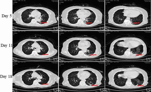Figure 10. Chest CT scans on days 5, 11 and 18 after onset for Pt-8. CT showed scattered bilateral multiple high-density effusions, faintly exudative shadows along the lungs especially in the left lung on the fifth day. Effusions were gradually absorbed over time. Red arrows indicate typical lesions.