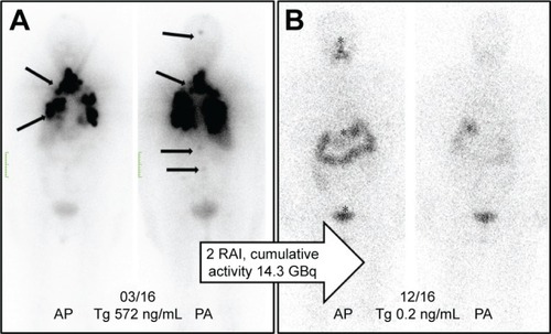 Figure 2 (A) Initial 131I-planar images of a 74-year-old female with metastatic thyroid cancer (lung, bone, and intracranial soft-tissue metastases, marked with arrows). The tumor marker thyroglobulin (Tg) before radioiodine therapy (RAI) was 572 ng/mL. (B) After two administrations of RAI (cumulative activity: 14.3 GBq), the patient was in complete remission with the Tg at 0.2 ng/mL. The planar images show only a physiological uptake of the radiotracer in the gastrointestinal tract and pharyngeal mucosa (marked with an asterisk).