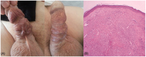 Figure 3. (A) Penile Kaposi’s sarcoma macroscopic view. (B) Vascular tumor lesion showing plaque and nodular pattern under a solid zone in the subepidermal area H & E ×40.