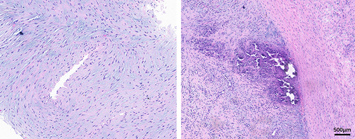 Figure 3 Arterial wall tissue had extensive mucoid degeneration with poor muscular structure and calcification and granulation tissue in some areas.