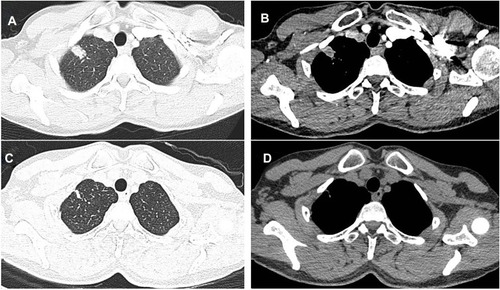 Figure 1 Case 1. CT findings in the right-superior pulmonary lobe. (A and B) A 1.7×1.4cm nodule was found at the initial diagnosis of pulmonary tuberculosis. (C and D) The nodule was almost absorbed after six months of chemotherapy.