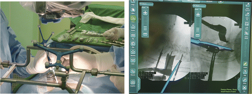 Figure 2. Left: A dynamic navigation frame was attached to the operating table with an external frame. In this configuration, navigation can be implemented while maintaining the microscopic view. Right: IGN is useful in the axial plane and also in the sagittal plane.