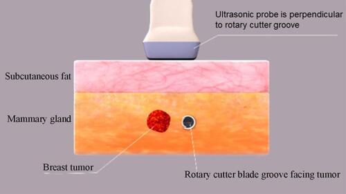 Figure 2 Schematic illustration of horizontal rotary cutting. The rotary cutter slot is directly lateral to the level of the breast mass and the ultrasound probe is perpendicular to the rotary cutter slot.