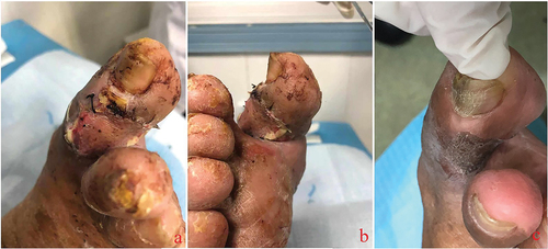 Figure 5. After successful reconstruction of the transplanted wound bed, anterior tibial free skins were used for skin grafting. The L-PRF group had a higher rate of skin graft survival, the well-surviving skin had no necrosis or infection, and the color of the skin was similar to that of normal tissue. (a, b). Well-recovered skin at an average of one-year postoperative follow-up showed good coverage of the ulcer wounds (c). The hyperplasia and skin graft area had good abrasion resistance.