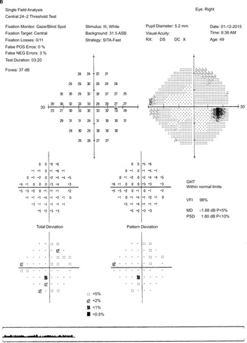 Figure 1 Humphrey visual field test showed normal visual field in the right eye (A) and diffuse depression of visual field in the left eye (B).