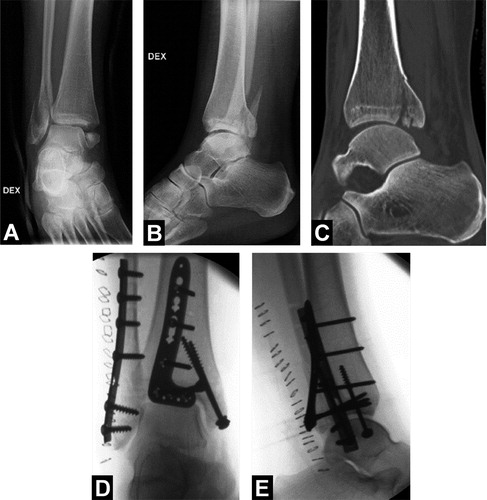 Figure 1. A and B.The trimalleolar ankle fracture following closed reduction at the emergency department. C. Computed tomography revealing the extent of the posterior malleolar fracture. D and E. Intraoperative fluoroscopic images.