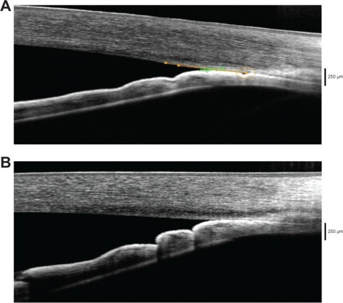 Figure 2 Angle remains closed after laser iridoplasty at untreated area.