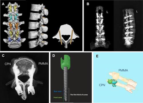 Figure 2 Radiological evaluation of cement-augmented cortical bone trajectory (CBT) screws.