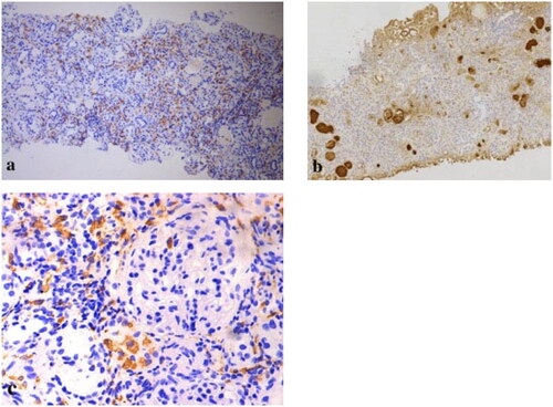 Figure 5. Immunohistochemical stains for immunoglobulins confirm the nature of the crystalline inclusions within the histiocytes. Immunoreactivity for kappa light chain is strong within the histiocytes as well as in the plasma cells, which demonstrates kappa light chain restriction. Immunohistochemistry showed that there were histiocytosis in renal interstitium (a: CD68, 100 × original magnification; b: κ, 100 × original magnification; c: CD68, 400 × original magnification).