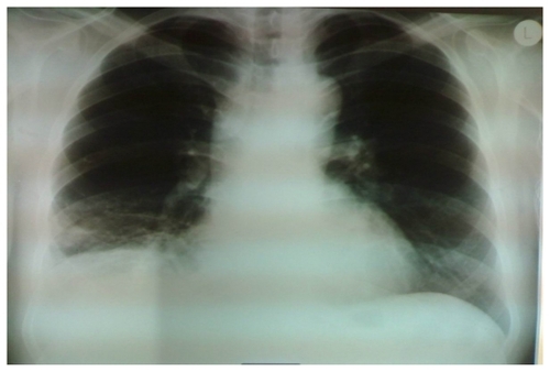 Figure 1 Chest radiograph, demonstrating prominent hilar shadows bilaterally, opacity at the lower lobe of the right lung, and elevation of the ipsilateral hemiseptum.