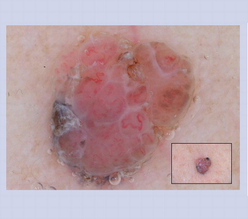 Figure 19. Nodular melanoma.This lesion lacks clinical ABCD features; however, it does reveal irregular serpentine blood vessels, which are melanoma predictive structures, as noted in Table 3.