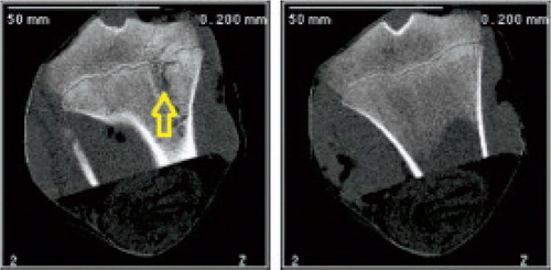 Figure 4. CT images taken 24 weeks after the procedure. Left panel: treated tibia. A bone bridge can be seen at the ablation site (arrow). Right panel: control, contralateral tibia.