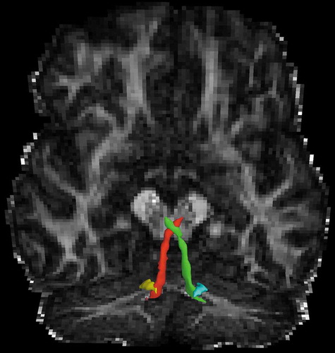 Figure 2. Outflow pathways of the superior cerebellar peduncle (left: red; right: green) and inferior cerebellar peduncle (left: yellow; right: cyan), superimposed on the fractional anisotropy map, in which there was significantly elevated diffusion parameters in the patient with the SPG7 mutation relative to controls.