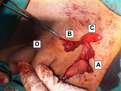 Figure 2 Left polyorchidism with separate epididymis and vas. A. abdominal testis, B. atrophic inguinal testis, C. inguinal incision with visible internal ring D. Contra-lateral descended testis.