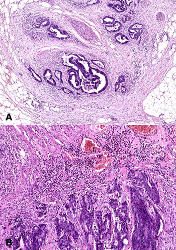 Figure 1 Histological images of colorectal cancer. (A) Colorectal adenocarcinoma with neural invasion. 50× magnification. (B) Colorectal adenocarcinoma with strong inflammatory cells infiltration. 100× magnification.