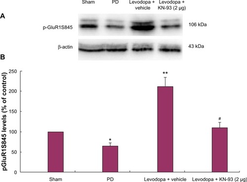 Figure 4 Intrastriatal KN-93 treatment reduced pGluR1S845 levels in PD rats. Total protein levels and membrane levels of GluR1 were decreased in PD rats. (A) Typical immunoblot images detected by an antibody against pGluR1S845. (B) pGluR1S845 levels in the membrane were decreased in PD rats compared to sham-operated rats. Repeated administration of levodopa increased the level of pGluR1S845 in PD rats. Conversely, intrastriatal KN-93 treatment reduced the increase in pGluR1S845 induced by repeated levodopa administration. Data are presented as mean ± standard error of the mean (error bars). *P < 0.05 versus sham; **P < 0.01 versus PD; #P < 0.05 versus Levodopa + vehicle; n = 5.