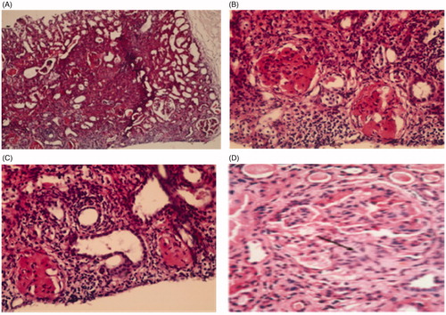 Figure 2. Histopathological pattern of nephrotic syndrome. (A) Section showed focal affection of glomeruli, tubular atrophy and interstitial fibrosis H & E × 100. (B) Glomeruli showed segmental area of sclerosis with mesangial proliferation, and interstitial fibrosis H & E × 400. (C) Glomeruli showed segmental area of sclerosis, tubules atrophied with interstitial fibrosis H & E × 400. (D) Section showed lobulated glomerulus with segmental glomerulosclerosis (arrow) and moderateglobal hypercellularity, H & E × 400.