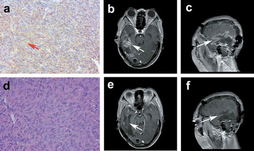 Figure 2. (a) The brown–yellow granules of the cell membrane and cytoplasm of vascular endothelial cells showed positive VEGFR2 (a × 100). Contrast-enhanced MRI (ceMRI) before treatment: transversal (b), and sagittal (c). ceMRI after treatment: transversal (e), and sagittal (f). e pathology of AE grade 3 (d × 200).