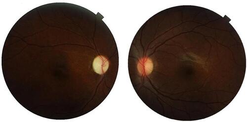 Figure 2 Fundus photograph of both eyes at the end of 1 year follow up. Optic atrophy with attenuated vessels is evident in the right eye whereas the fundus is within normal limits in the left eye.