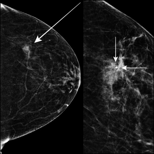 Figure 1 In 2017, a 65-year-old female patient presented with left breast lumpiness to the symptomatic breast unit. Mammography revealed an indeterminate, low-density area within the upper outer quadrant of the left breast (long arrow). This was subject to core biopsies and subsequent titanium clip placement (short arrows).