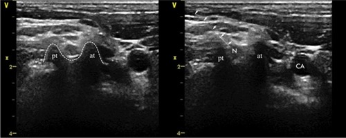 Figure 1 Axial transverse ultrasound images of the anterior tubercle and the posterior tubercle of C5.