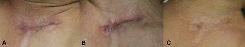 Figure 3 Female, 2 years old, (A) Is one month post-treatment, (B) Is three months post-treatment, and (C) Is six months post-treatment.