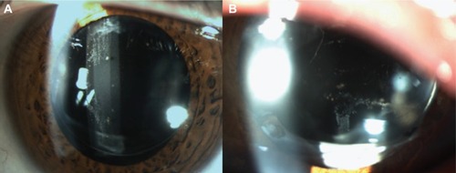 Figure 2 Deposition of XFM on the posterior surface of intraocular lenses.
