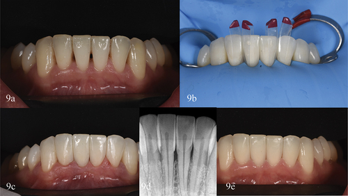 Figure 9. Clinical case VII. (a) Initial lower intraoral front view. (b) Detail of the isolated teeth, the small red specific matrices for black triangles installed can be seen, to do the injection molding procedure at the same time (black triangle kit. Bioclear matrix systems. Bioclear). (c) Two weeks clinical review. (d) Two weeks radiograph control, (e) Two years review, highlighting the stability of periodontal health and good polish.