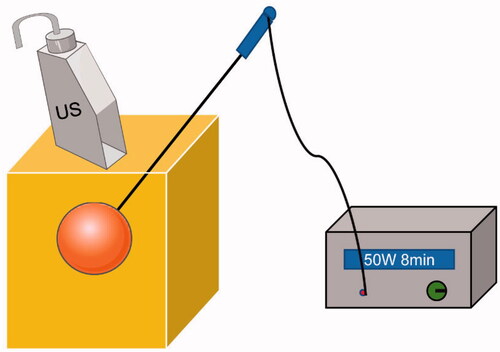 Figure 2. Schematic of the US-guided microwave ablation (MWA, a form of thermal ablation). The ablation needle was advanced into the tumor under US guidance, and the microwave therapy instrument started with fixed parameters: 50 W and 8 min.