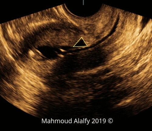 Figure 1 2D SHG image in a sagittal section of the uterus showing the triangular cesarean scar niche.