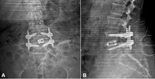 Figure 6 After pedicle screw insertion from AP (A) and lateral (B) view.