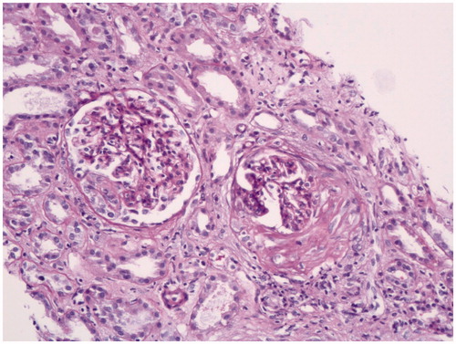 Figure 1. Glomerulus with fibrocellular crescent at right and with early cellular crescent at left (H&E × 100).