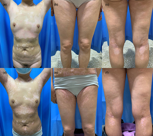 Figure 2 Clinical photographs of patient 2 before and after baricitinib treatment. Multiple, hypopigmented-to-depigmented patches on the trunk and extremities. (a–c) Significant repigmentation on the trunk and extremities after twice-daily oral baricitinib application for 6 months. (d–f).