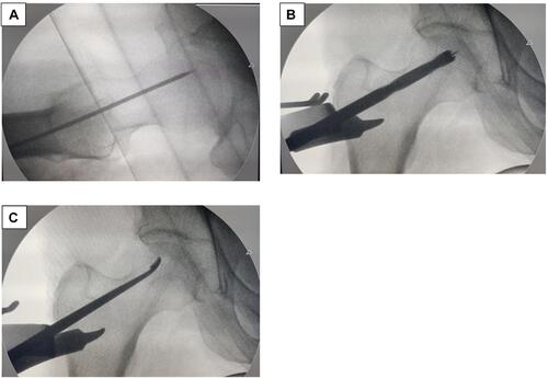 Figure 2 Steps of osteoblasts implantation. (A) Step 1 – Insertion of guide wire in center of lesion as identified on the MRI. (B) Step 2 – Guide wire and 8mm cannulated drill for core decompression. The entry point of the guide wire is near the vastus ridge, to prevent a fracture due to stress-riser, greater width of femur and faster healing due to cancellous bone. (C) Step 3 – Curettage: a variety of angulated curettes is used to do forage (curettage to remove necrotic bone). This bone is sent for biopsy.