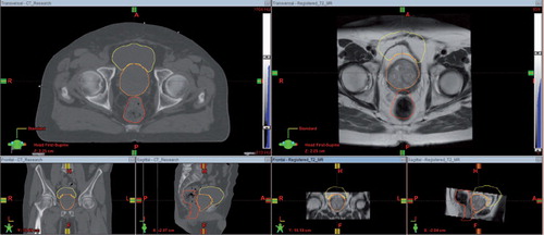 Figure 1. Left: Radiotherapy planning CT acquired on a Philips Brilliance Big Bore CT scanner fitted with a flat couch. Right: T2-weighted MR image set acquired on a Siemens Symphony 1.5T scanner without a flat couch, which has been co-registered to the planning CT volume so that the image sets have the same resolution and geometry. The bladder, prostate and rectum contours were originally defined on the planning CT and then mapped to the MR using a rigid registration transform. It is clear from the position of these structures on the MR images that rigid registration results in significant errors in cross-modality mapping.
