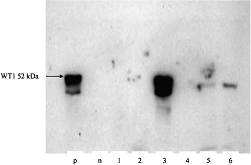 Figure 1. Western blot detection of Wt1 expression (52 kDa). p: positive control (cell line K‐562); n: negative control (cell line U‐937); lane 1–6: samples from AML patients. Semiquantitative probe evaluation: samples 1, 2, and 4 are negative (−), samples 5 and 6 are weekly positive (+) and sample 3 is strongly positive (+++).