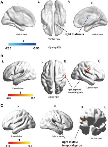 Figure 4 DKI analyses suggest brain structural changes in PHN patients after treatment. (A) AD value of right thalamus (Thalamus_R (aal)) was significantly reduced after treatment; (B) FA values in the right superior temporal gyrus (Temporal_Sup_R (aal)) increased after treatment; (C) AK values in the right temporal gyrus (Temporal_Mid_R (aal)) increased after treatment (P <0.05, AlphaSim correction). The blue color indicates the GMV is significantly reduced after treatment, and the red and yellow colors indicate the GMV is significantly increased after treatment.Abbreviation: aal, anatomical automatic labeling.
