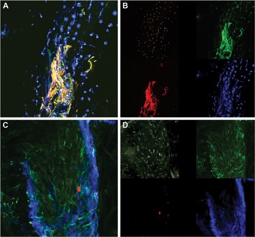 Figure 4 Epiretinal membrane immunocytochemistry analysis using (A, B) a combination of anti-vimentin (green), anti-GFAP (red), ricin (blue), and Hoescht (white) and (C, D) a combination of anti-vimentin (green), anti-Mib1 (red), ricin (blue), and Hoescht (white).