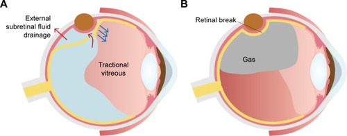 Figure 5 Intraocular gas tamponade can be an effective adjuvant for scleral buckling when external drainage of SRF fails to close the break because of the extensively liquefied vitreous.