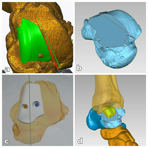 Figure 4. The design of 3D-printed prothesis. (A) The affected area of medial talar trochlea (green area). (B) The view of the talus after the osteotomy of affected medial talar trochlea. (C) Top view of the prosthesis placed on the talus and pre-drilled holes for screws in the prothesis. (D) The view of ankle after installation of prosthesis.