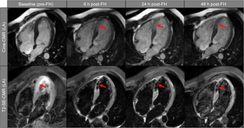 Figure 4 Exemplary cardiac magnetic resonance images in the long-axis view of a study patient with a septal myocardial infarction who underwent pre-Feraheme™ (AMAG Pharmaceuticals, Waltham, MA, USA) (baseline) and post-FH (after 6, 24, 48 hours) cardiovascular magnetic resonance imaging studies, respectively.Notes: The first line shows cine-CMR images at different time points with proof of hyperenhancement in the septal wall at 6–48 hours post-FH (red arrows). The second line shows T2-weighted short-tau inversion recovery spin-echo images at different time points with proof of hypoenhancement in the septal wall at 6–48 hours post-FH (red arrows). Reproduced with permission from Yilmaz A, Dengler MA, van der Kuip H, et al. Imaging of myocardial infarction using ultrasmall superparamagnetic iron oxide nanoparticles: a human study using a multi-parametric cardiovascular magnetic resonance imaging approach. Eur Heart J. 2013;34(6):462–475, by permission of Oxford University Press on behalf of the European Society of Cardiology.Citation4Abbreviations: cine-CMR, cine-cardiovascular magnetic resonance; h, hours; FH, Feraheme; LA, long-axis.