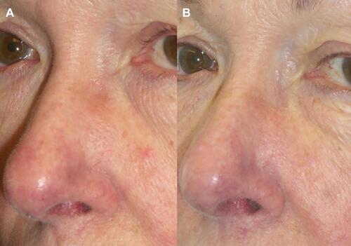 Figure 1 Before (A) and post one year (B) following 2 PDL treatments for erythema of the nose. Figure courtesy of Dr. Goldman.