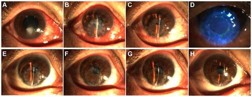 Figure 8 Another successful graft transplantation in the infectious peripheral corneal ulcer group. (A–D) Before surgery (A) and at 1 day (B), 7 days (C and, D), 1 month (E), 3 months (F), 6 months (G), and 12 months (H) postoperatively.