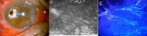 Figure 1 (A) Obvious conjunctival congestion, with white opacity on the temporal side of the cornea and visible brown foreign body in his right eye; (B) Confocal microscopy revealed abundant hyphae structure at the lesion of the right cornea; (C) Calcofluor white staining of corneal scrapings showed abundant septate hyphae.