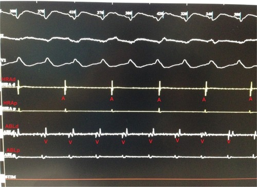 Figure 3 Tracing from the electrophysiology study showing ventricular tachycardia intracardiac electrogram during ventricular tachycardia.
