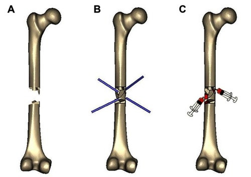 Figure 1 The steps of the procedure. (A) Fracture nonunion; (B) multiple drilling of the nonunion site from different angles; (C) autologous bone marrow grafting.