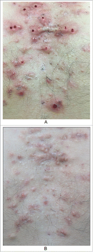 Figure 5. The patient with keloids in the chest. A. Before B. After four months treament of glucocorticoid and 5-fluorouracil, leaving a lot of blackheads and epidermoid cysts.